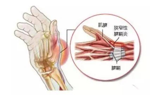 人均腱鞘炎_手腕腱鞘炎图片(2)