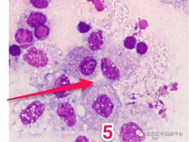 5. 退化的间皮细胞