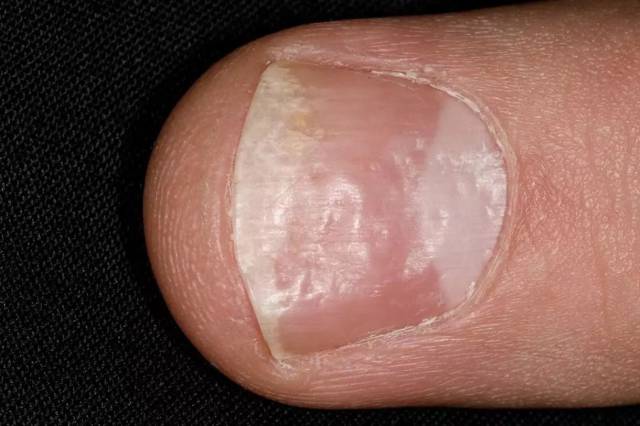 患湿疹时也可出现指甲上有小凹陷的情况,这是由于 皮肤和指甲干燥