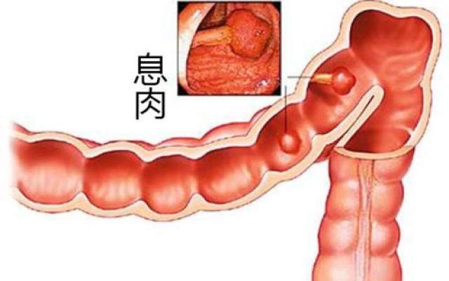 结肠息肉严重吗?