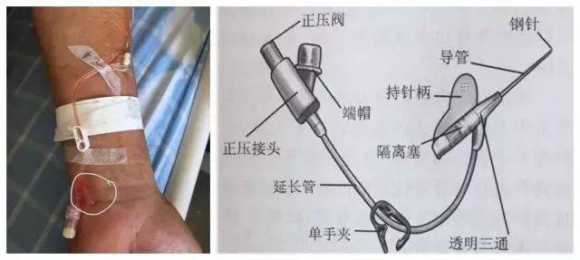 随着医学科学的迅速发展,静脉留置针已作为临床输液治疗的一种主要