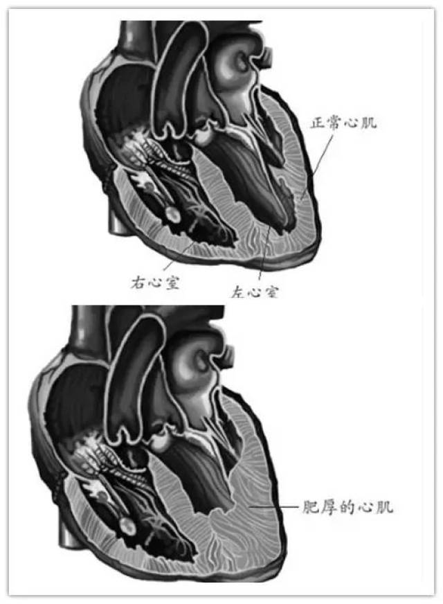 病的心脏结构有什么特点 肥厚型心肌病显著的解剖特征是心室壁肥厚,不