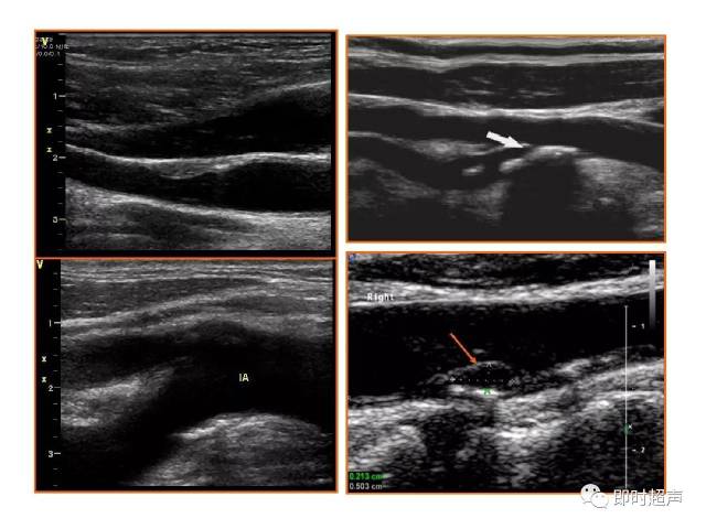 颈部血管超声正常解剖及常见病的超声诊断标准