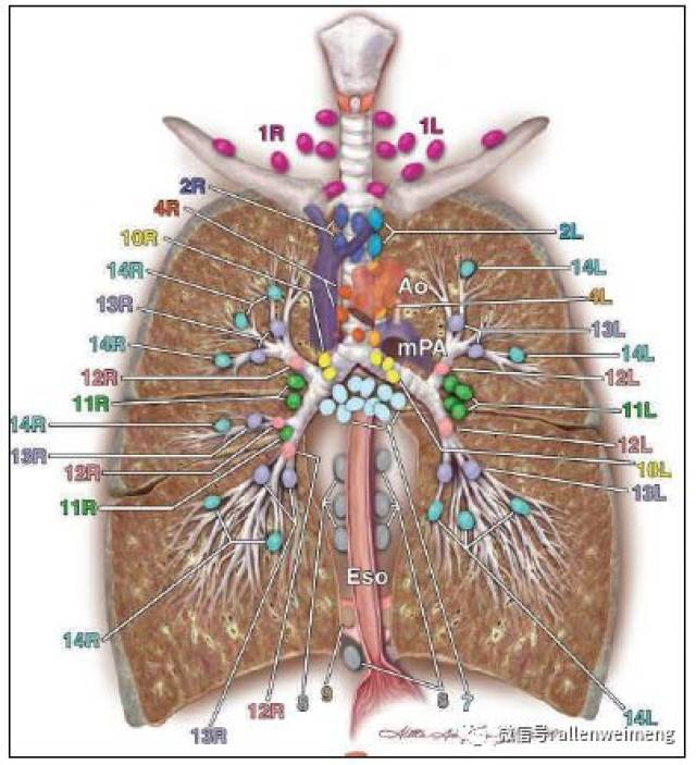 在这里,终于读懂肺癌纵隔淋巴结分组的真相