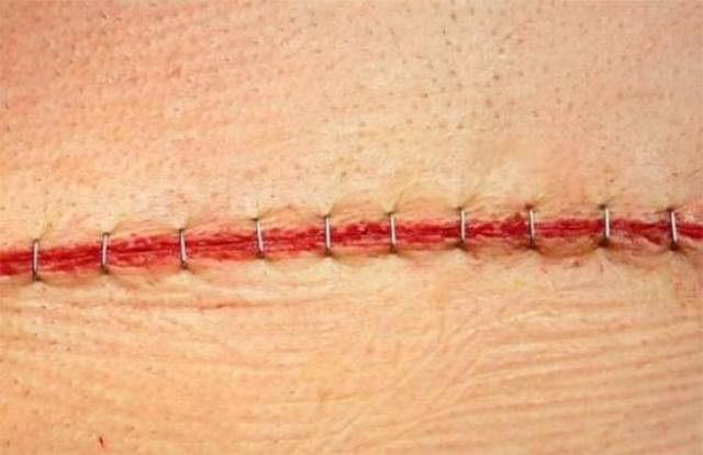 可吸收线就是常说的"美容线",缝合线可以藏在伤口里,皮肤表面是看不到