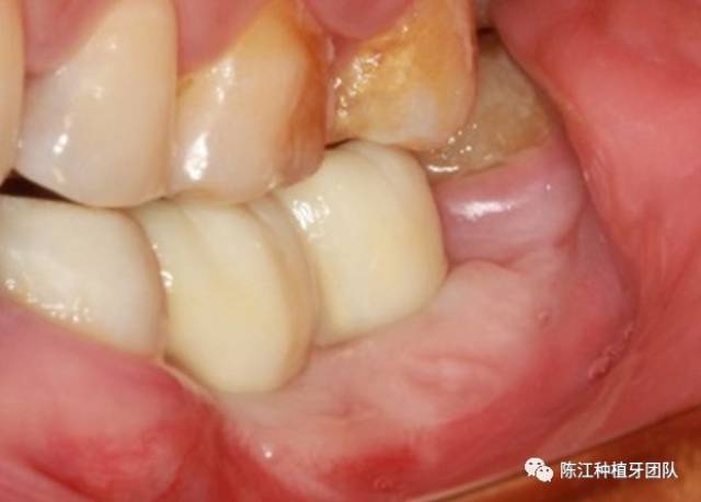 【病例分享】下颌后牙区种植同期角化粘膜移植一例