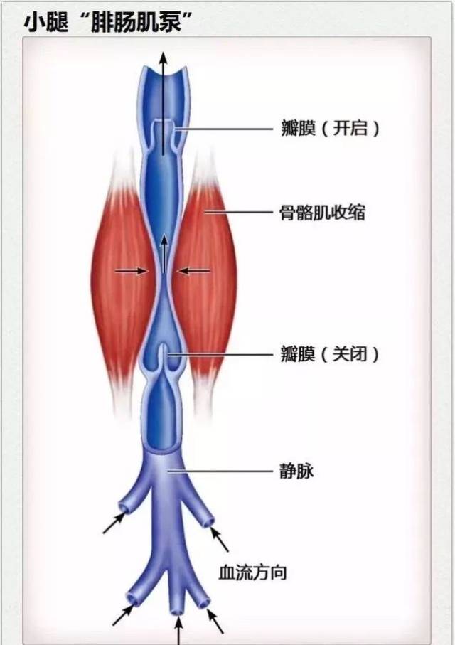 下肢静脉曲张是一个恶性循环,当静脉其中一个瓣膜关闭不全,失去输送