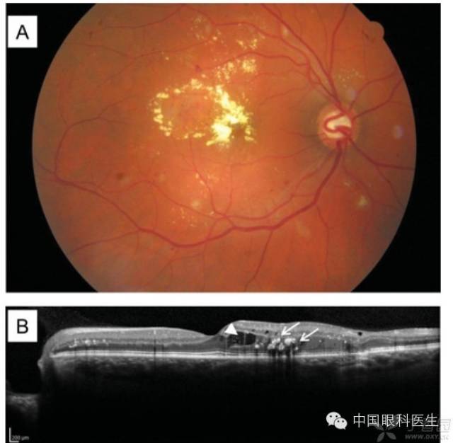 糖尿病视网膜病变面面观【超全图解析必收藏】