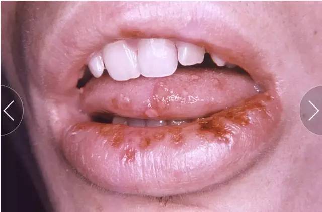 图示为「感冒疮」或称「口唇疱疹」(图片来源:美国 cdc/robert e.