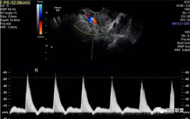 超声监测子宫动脉