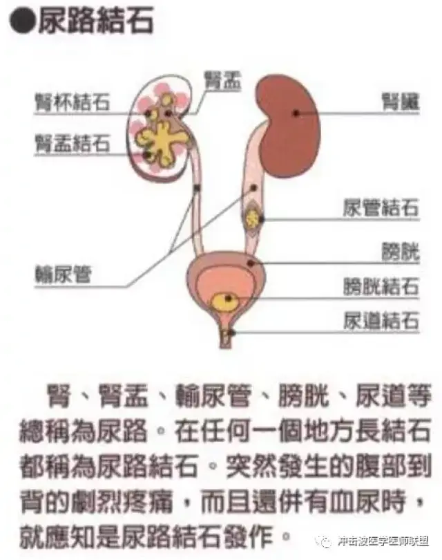 本研究结果表明结石位置(肾盂结石,肾中盏结石)是影响不良反应发生的