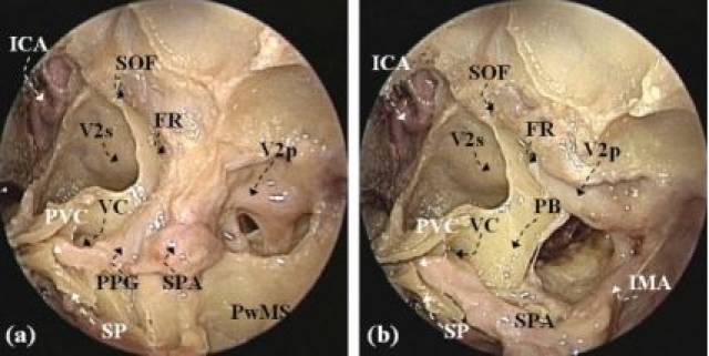 腭鞘管的解剖及临床意义palatovaginal canal(pvc)