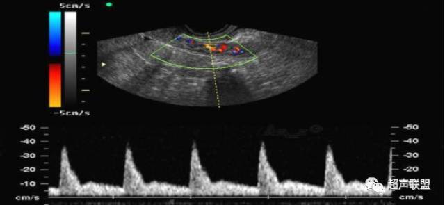 超声监测子宫动脉