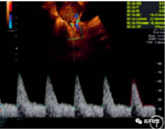 超声监测子宫动脉