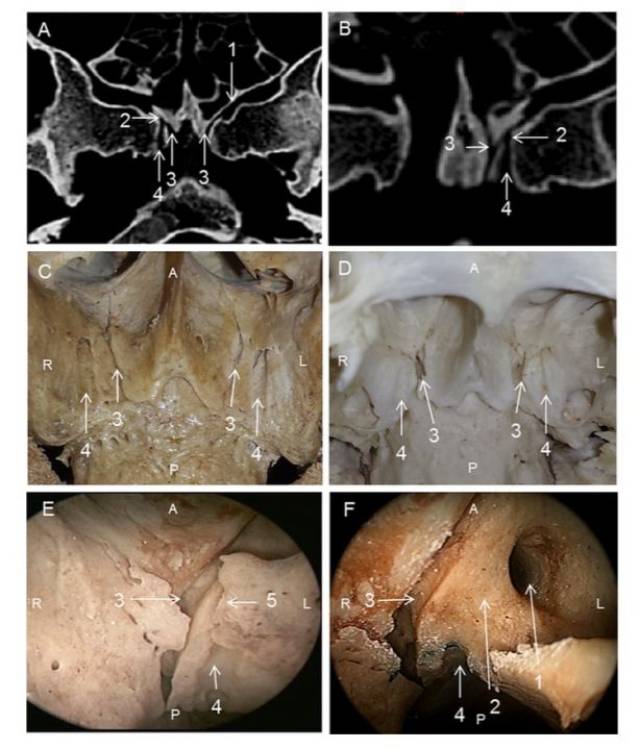 腭鞘管的解剖及临床意义palatovaginal canal(pvc)