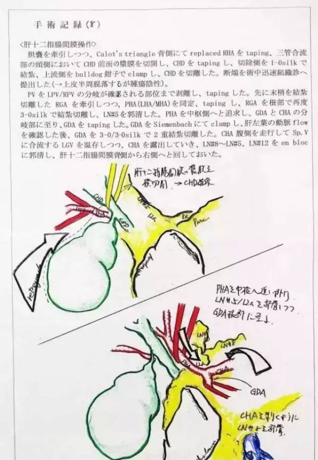 分离calot三角,离断胆囊动脉,将胆囊从肝面剥离.