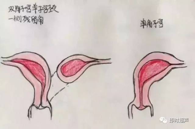 单角子宫:(1)子宫外形呈梭形,横径较小;子宫内膜呈管状,向一侧弯曲