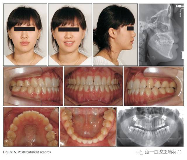 正畸治疗6年后,患者没有不适且维持了稳定的咬合关系.