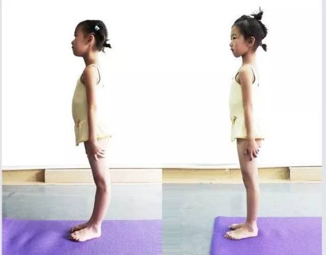 体态矫正之膝过伸的运动矫正,含视频课程