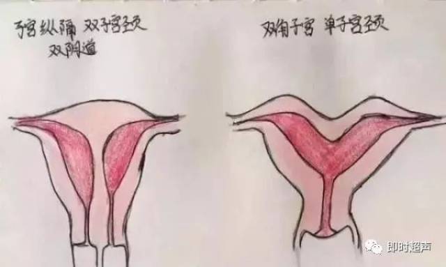 单宫颈管或宫颈管有分隔双子宫:双子宫的两侧子宫狭长,左右对称,经