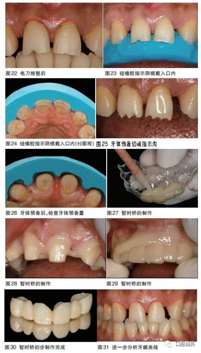 上前牙全瓷固定桥美学修复一例