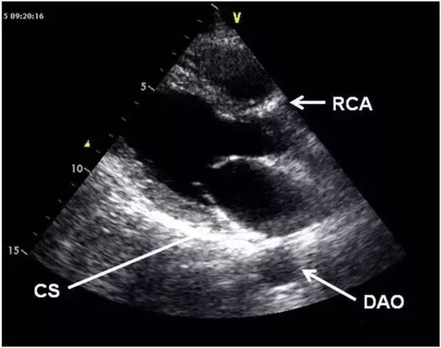 胸骨旁左室长轴切面.la.左心房;lv.左心室;ao.主动脉;rvot.