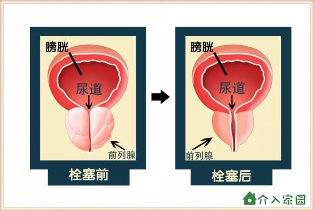 漫画科普│前列腺增生,你还在苦苦忍受么?