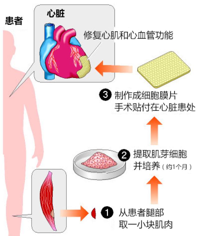 代替心脏移植-日本心肌心血管再生治疗