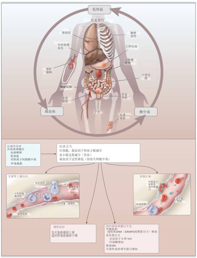 nejm综述:失血性休克