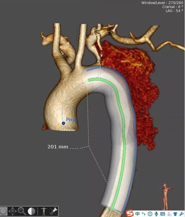 【病例分享】castor分支型主动脉覆膜支架系统治疗胸主动脉夹层