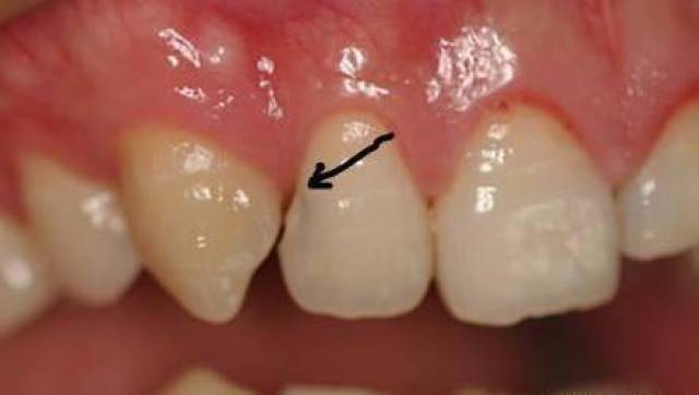 牙缝里为什么会长黑黑的东西?