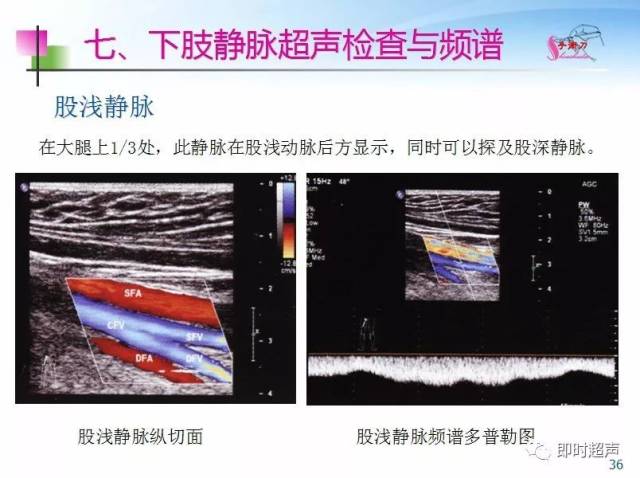 下肢血管的超声检查及正常声像图