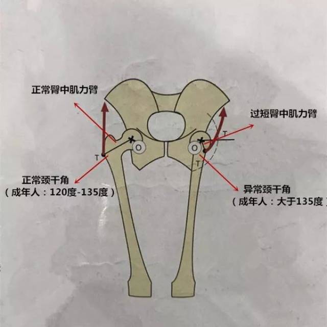 下截骨(恢复正常颈干角),关节清理,股骨头成形等方式,将髋关节的结构
