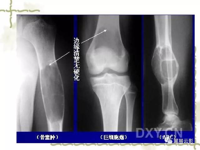 骨肿瘤诊断分析的基本要素,你都知道吗