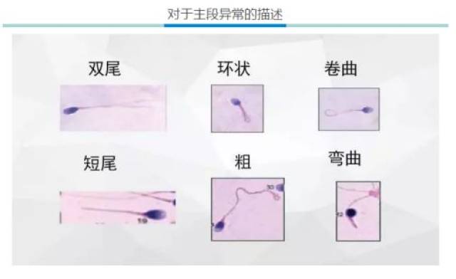 3.畸形精子:梨形头,中段弯曲,不规则,胞浆小滴过多 4.