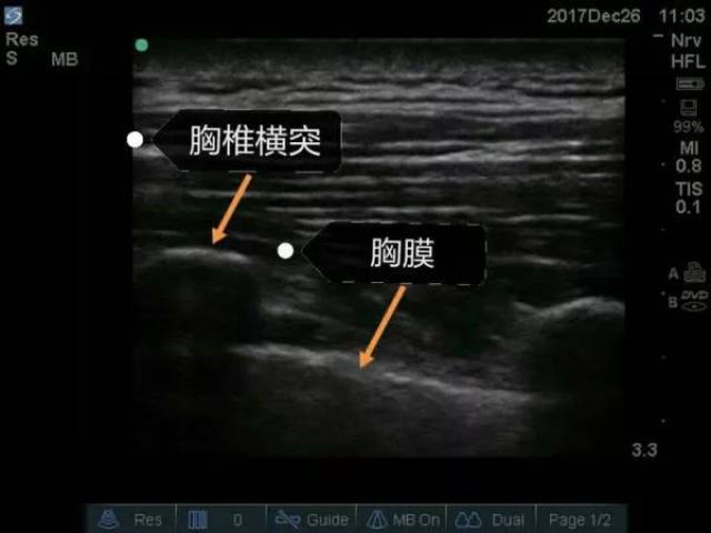 如何从零开始学习超声引导下神经阻滞?这篇文章你不可错过.