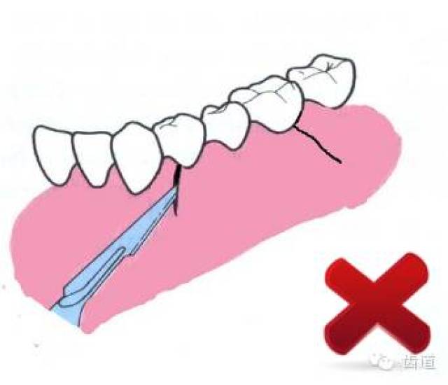 牙周改良widman翻瓣术的切口设计