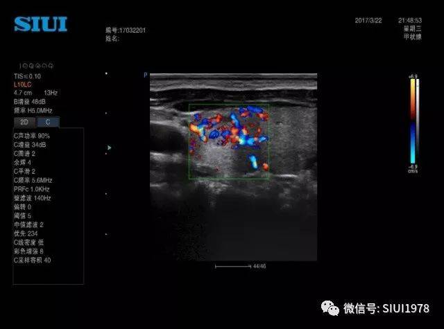 这些甲状腺超声诊断误区不要犯