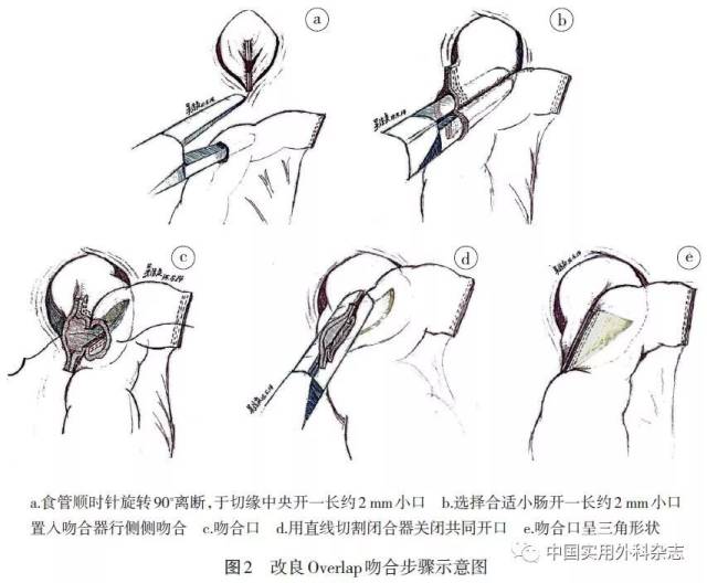 论著|腹腔镜下改良overlap法食管空肠吻合11例临床分析(本文配发视频)