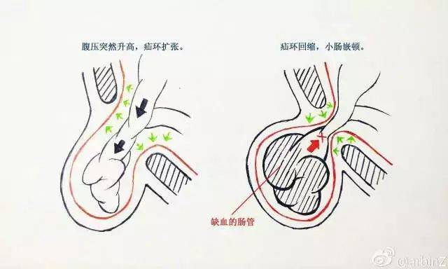 肚子上突然鼓出来一坨?别慌,这是疝气