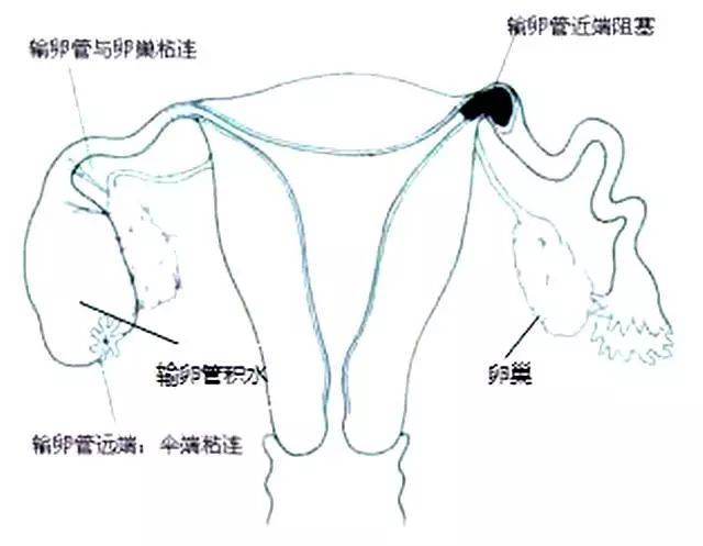 的症状,就会影响受精卵的正常运行,导致受精卵在宫腔之外的地方着床