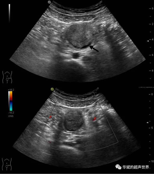 腹部超声:居无定所的包块