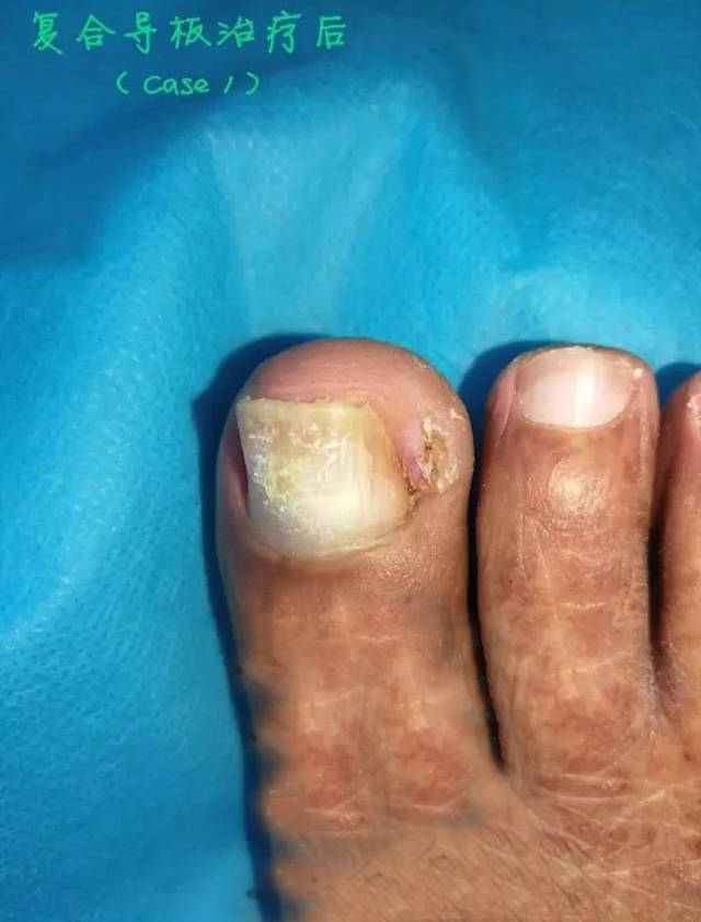 武汉协和医院副教授陈江海告诉您嵌甲性甲沟炎