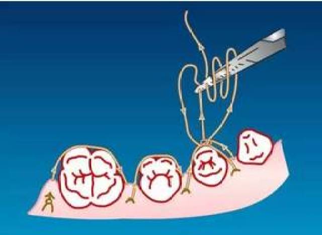 牙周缝合方法,99%的牙医都要知道
