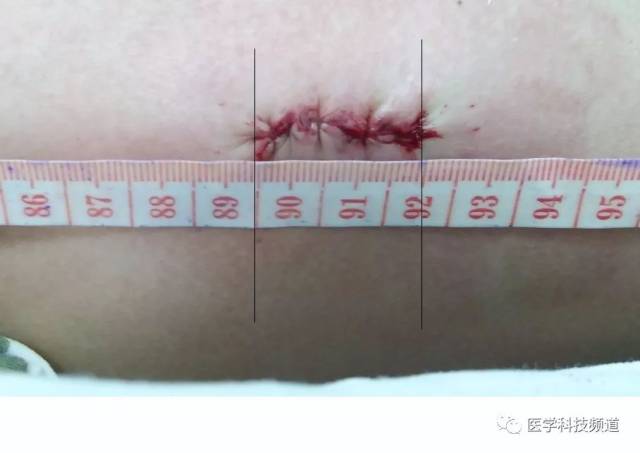 手术仅需要两个小切口,切口分别位于两侧胸壁,位置隐蔽,长度仅为