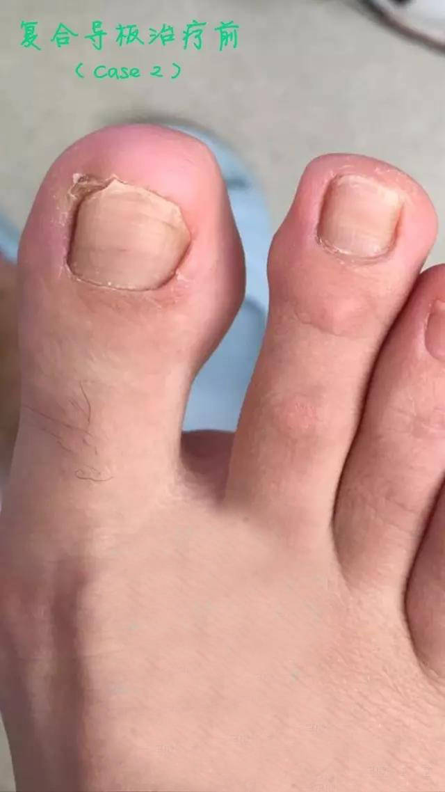 武汉协和医院副教授陈江海告诉您嵌甲性甲沟炎