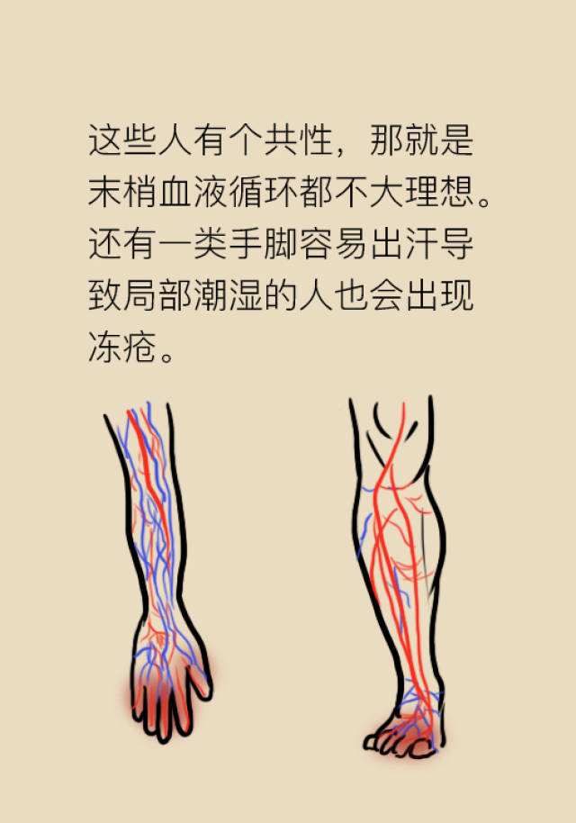 暖心科普,不要再有冻疮