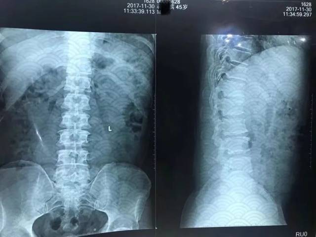 患者后背突出>2㎝,有点儿罗锅,烟台大大小小的推拿正骨店都去过,均未