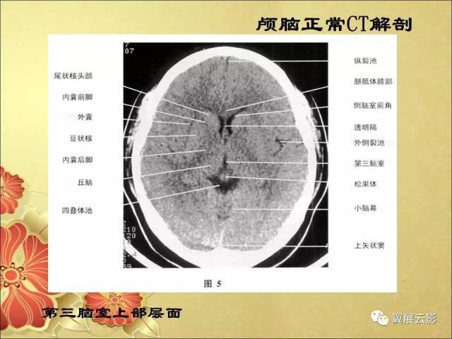 头部ct解剖及常见疾病的影像诊断