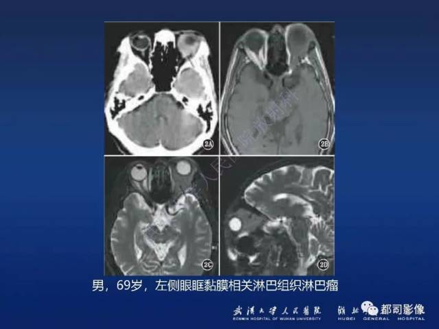 眼眶黏膜相关淋巴组织淋巴瘤影像诊断